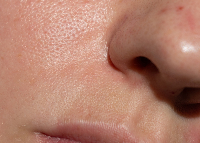 Before VirtueRF treatment 1