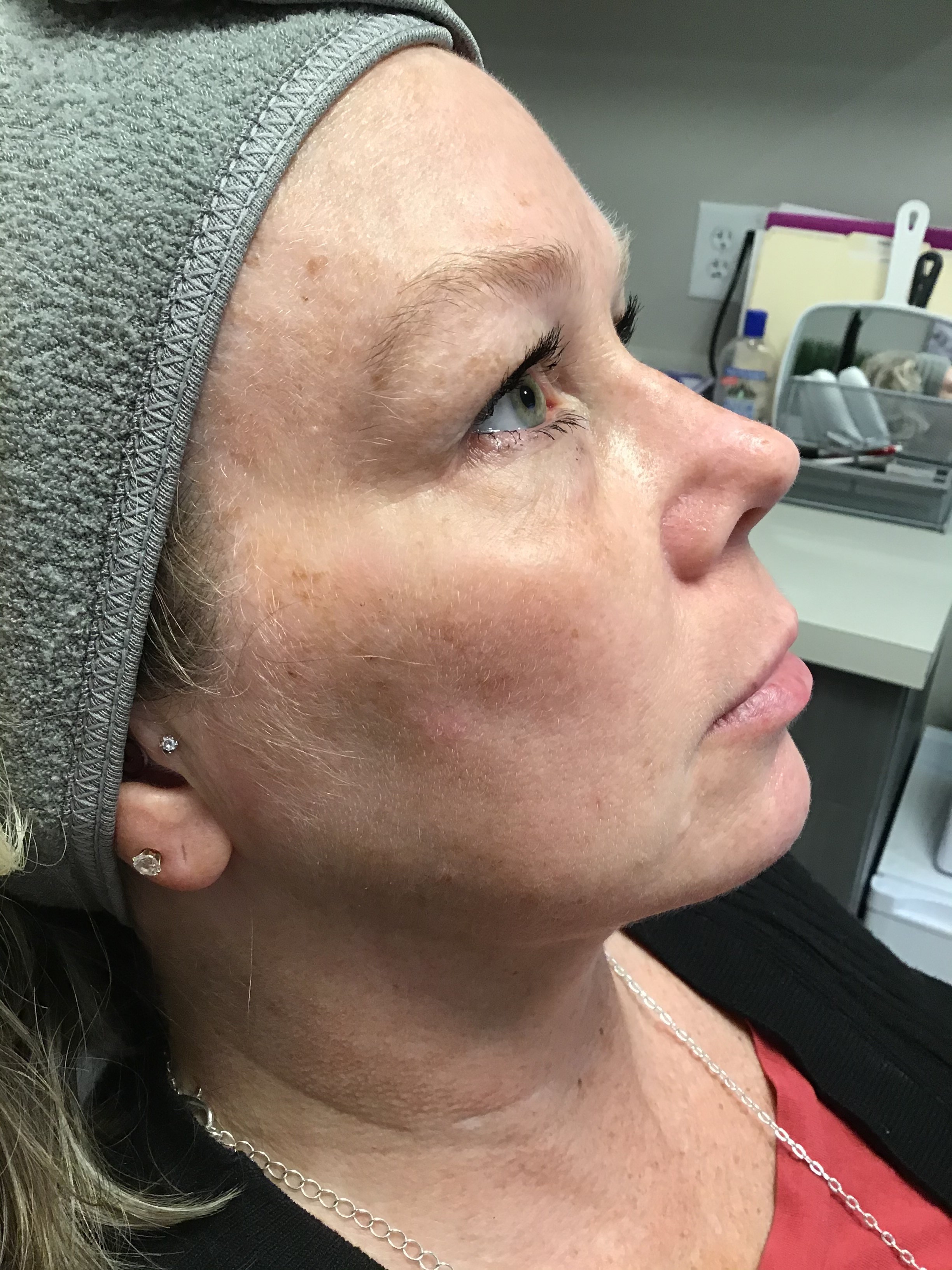 After Photofacial