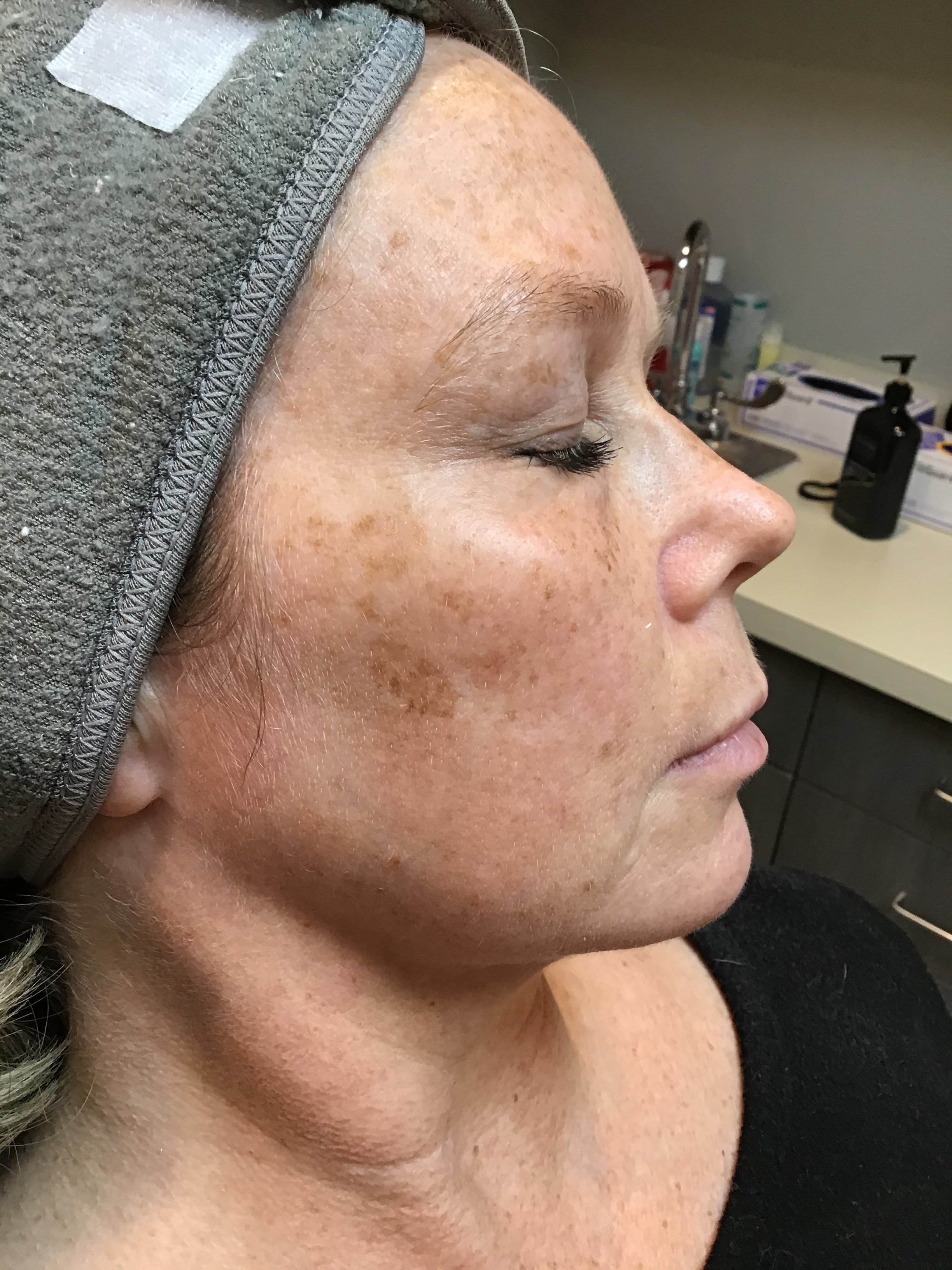 Before Photofacial